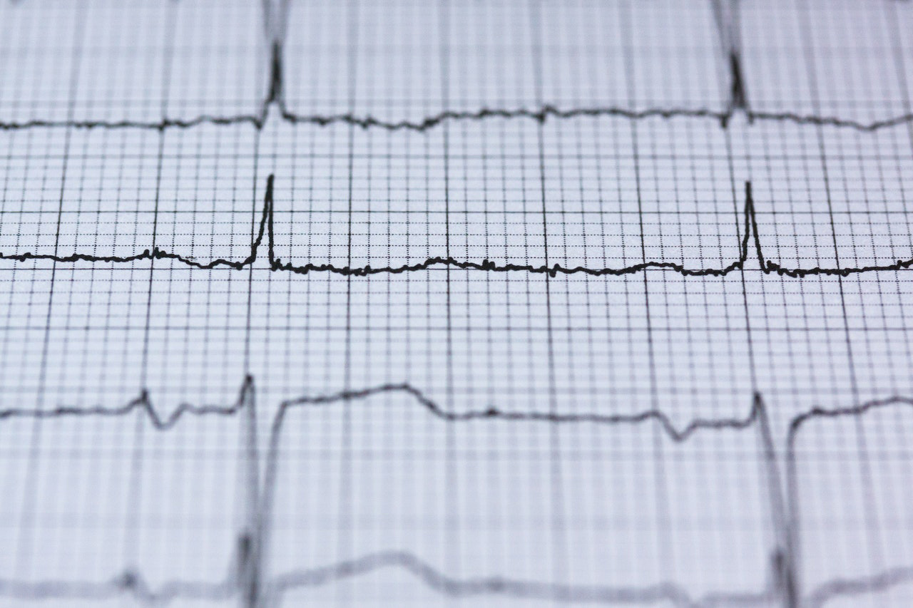 Sinuskurven der Herzaktivität - Symbolbild Telekardiologie